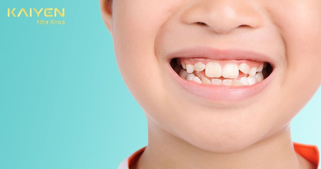 Trẻ bị lệch khớp cắn không nên bọc răng sứ