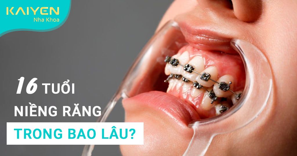 16 tuổi niềng răng bao lâu? Thời gian, phương pháp và những lưu ý cần biết