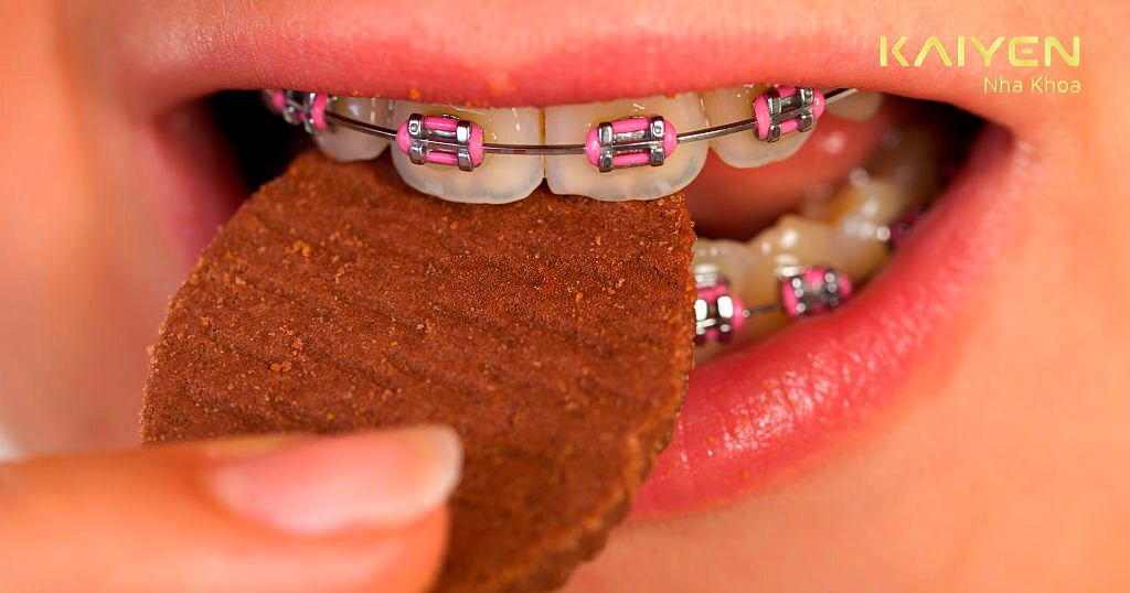 Chú ý vấn đề ăn uống trong thời gian niềng răng