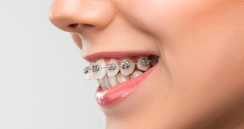 niềng răng kim loại phổ biến