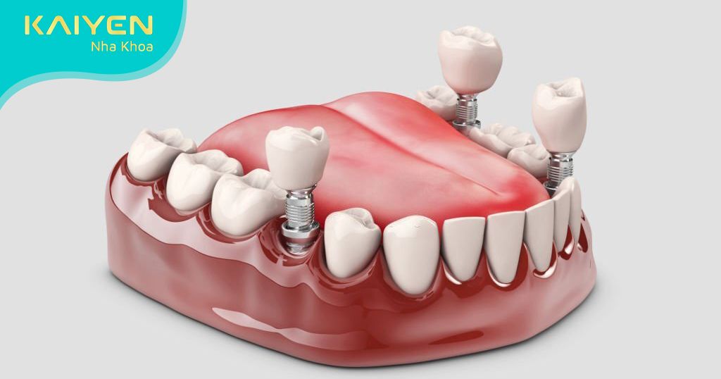 Tại sao nên cấy ghép Implant thay vì cầu răng sứ, hàm tháo lắp?