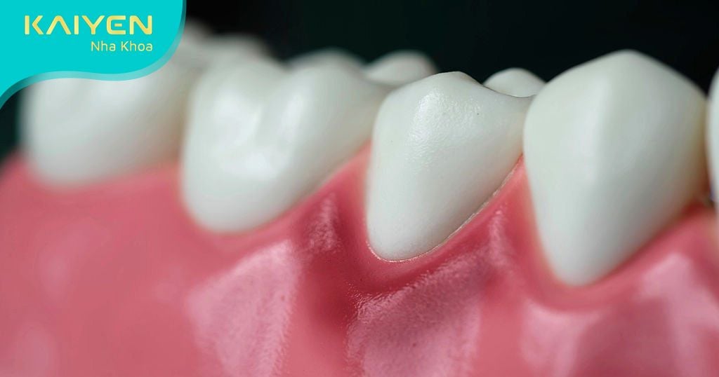 Xử lý triệt để bệnh lý răng miệng trước khi thực hiện cắm Implant