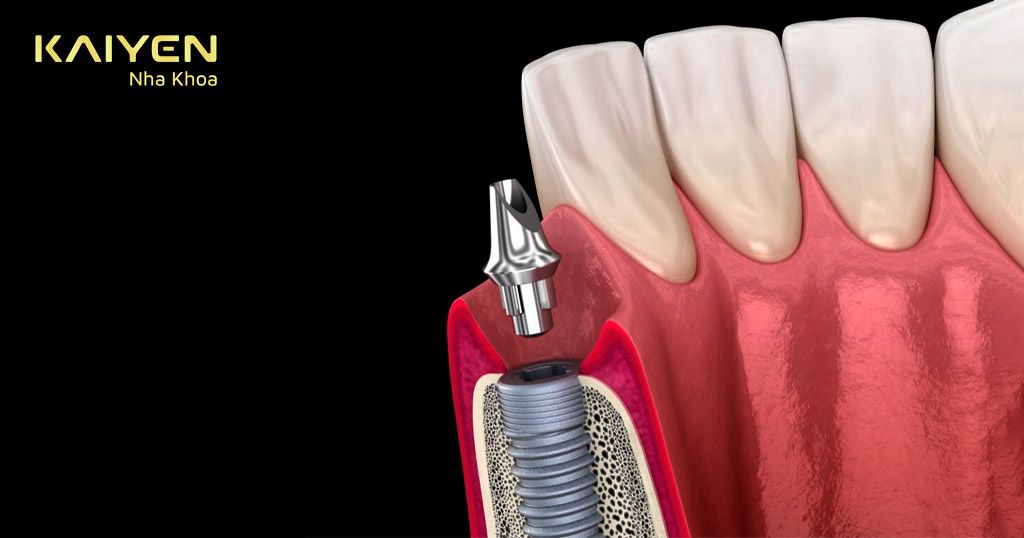 Abutment Implant là gì? Sử dụng như thế nào? Giá bao nhiêu?