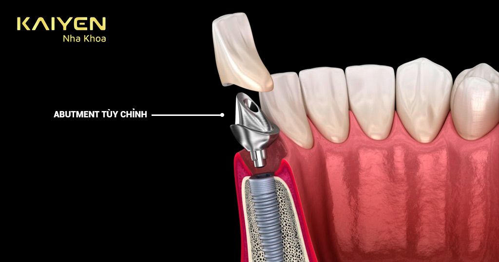 Abutment Implant tùy chỉnh