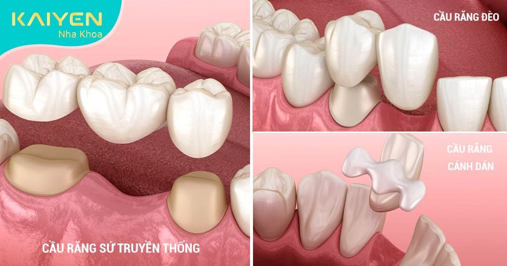 Các loại bắc cầu răng sứ phổ biến hiện nay