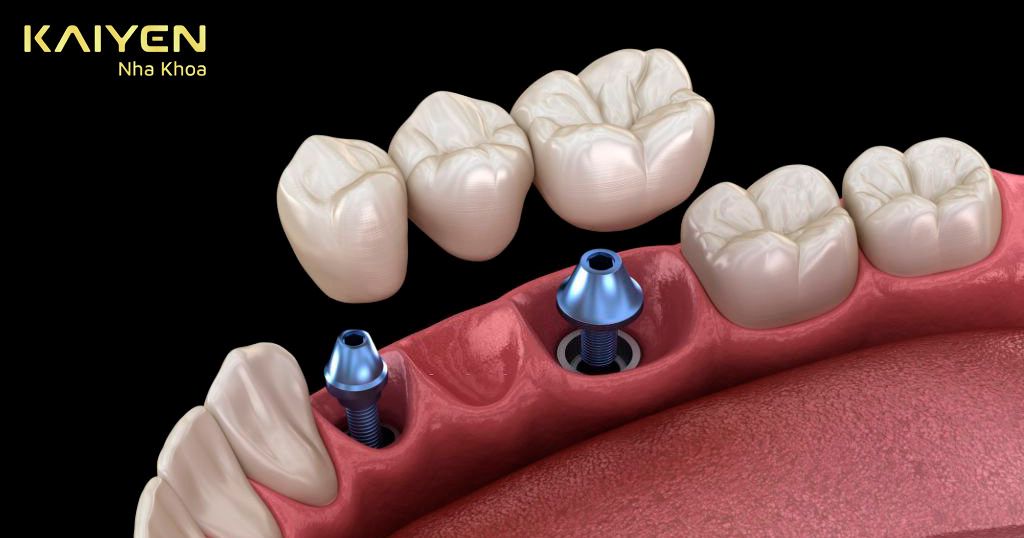 Làm cầu răng sứ trên các trụ implant