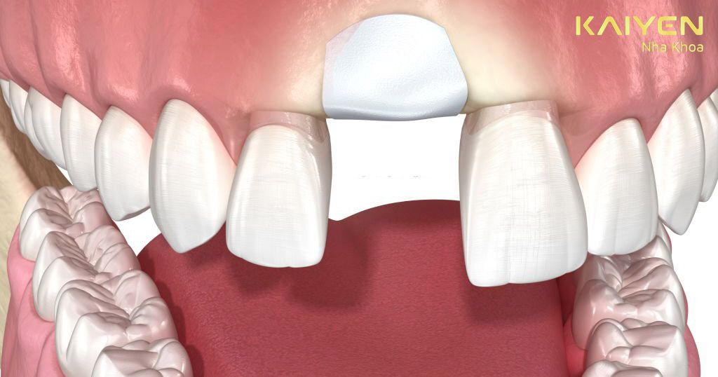 Cầu răng sứ sử dụng được bao lâu sẽ khác nhau giữa các vị trí phục hình