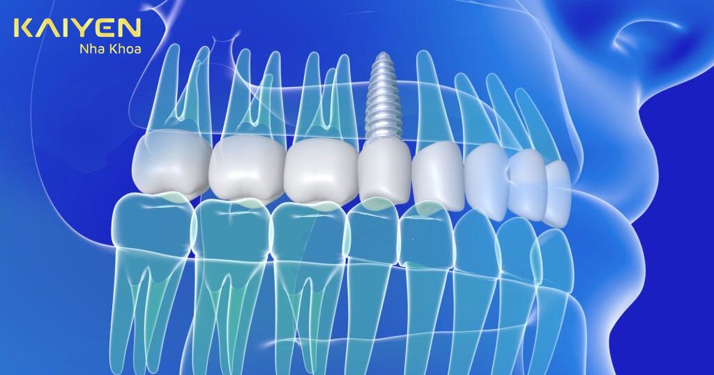Cấy ghép Implant sai vị trí gây đau khớp hàm