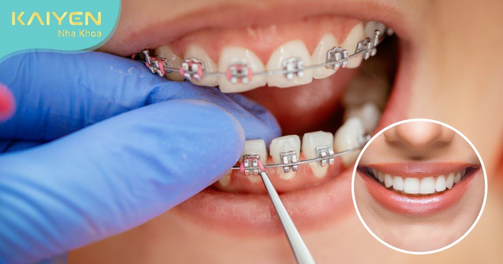 Chỉnh nha là kỹ thuật đưa các răng về đúng vị trí trên khung hàm