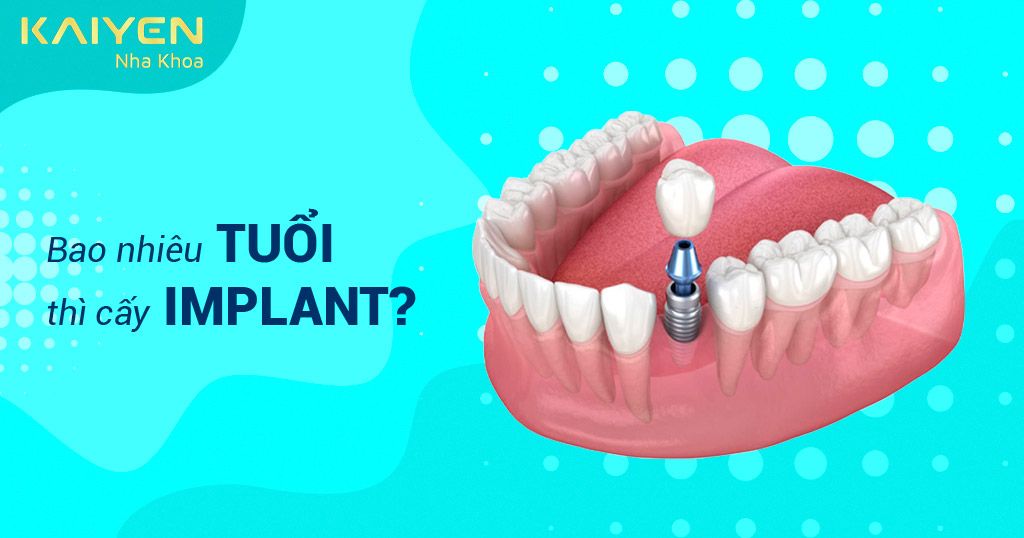 Bao nhiêu tuổi thì cấy Implant được? Độ tuổi trồng răng an toàn