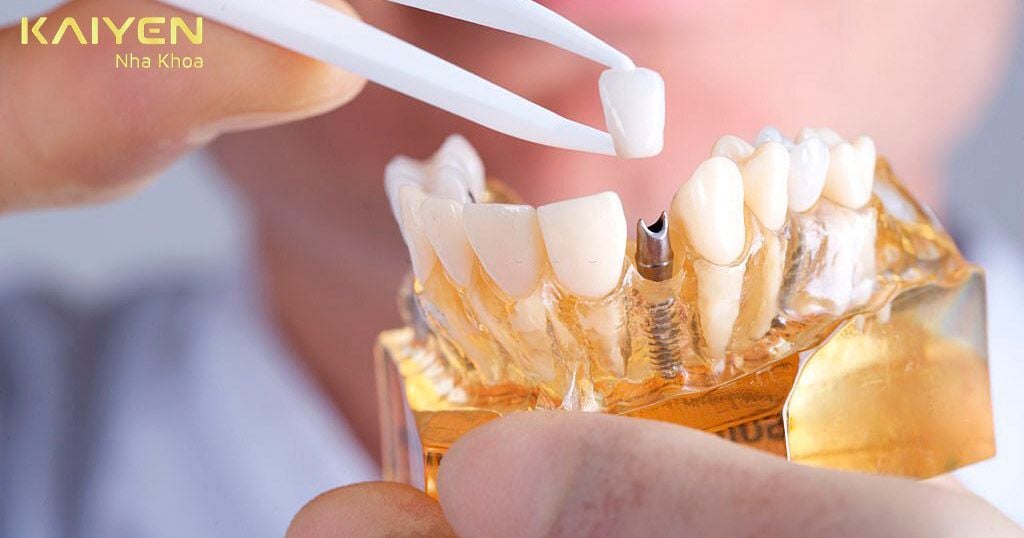 Trồng răng Implant là phương pháp phục hình ưu việt và hiện đại
