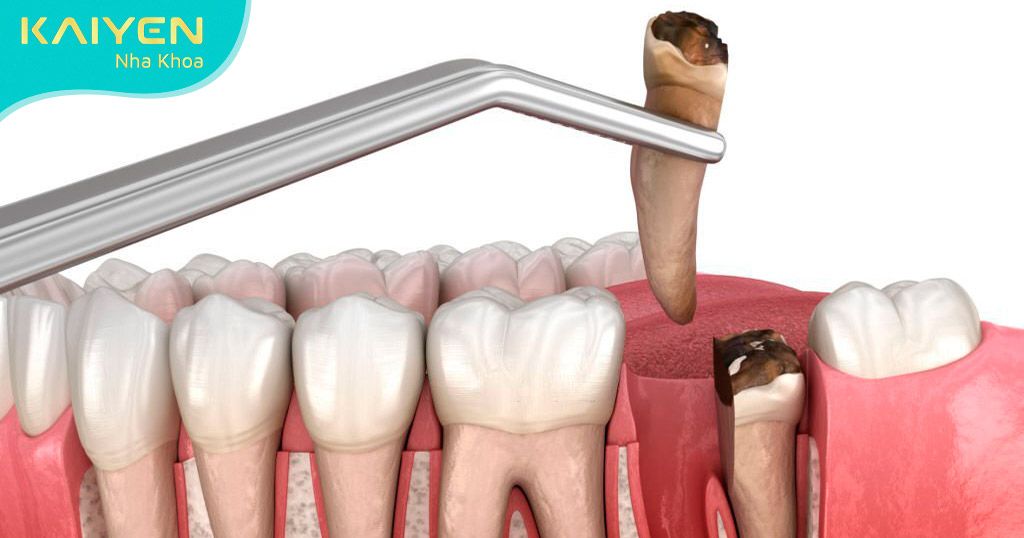 Người bệnh nên áp dụng cắm Implant ở trường hợp mất răng lâu ngày