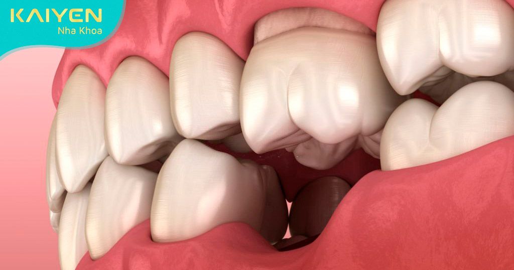 Loại bỏ răng hư hỏng mức độ nặng