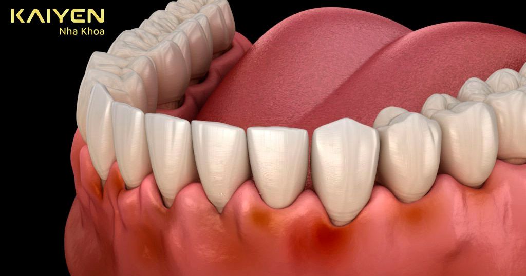 Bệnh lý răng miệng cần xử lý triệt để trước khi thực hiện cấy ghép Implant