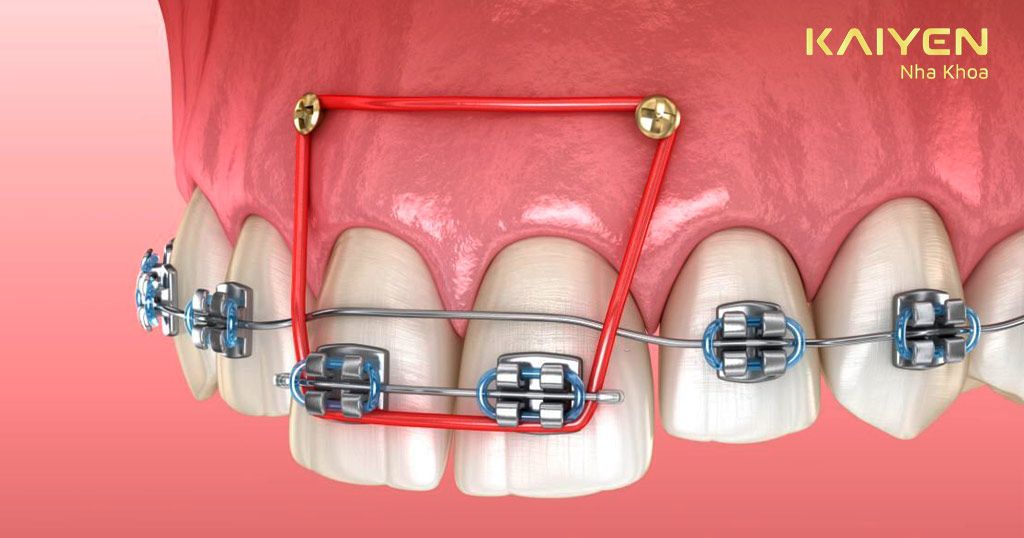 Trong một số trường hợp đặc biệt thì Minivis được đặt ở răng cửa hàm trên