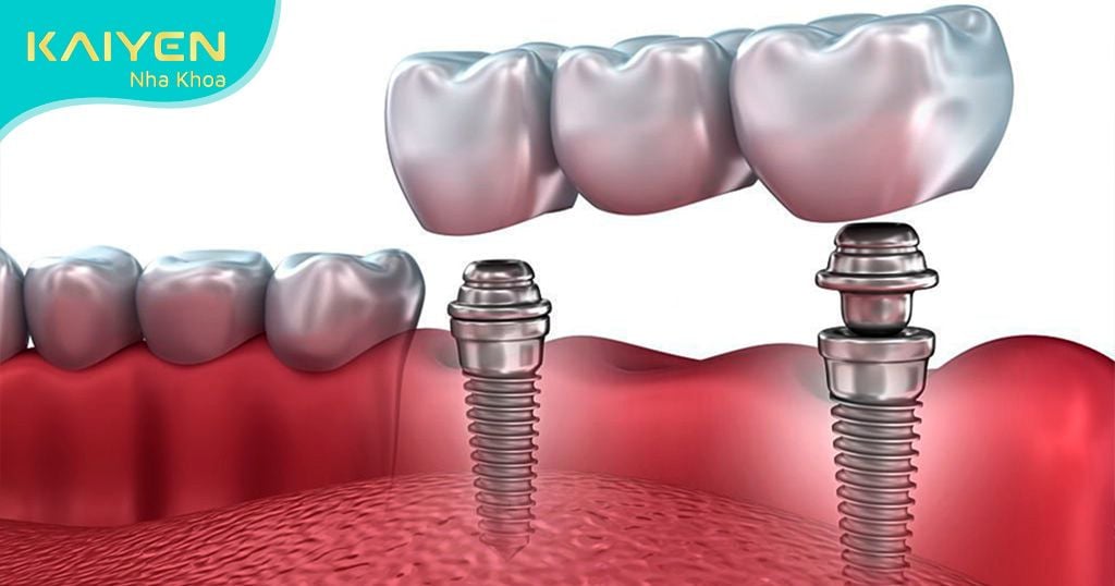 Phương pháp cấy ghép Implant - phục hình từ chân răng