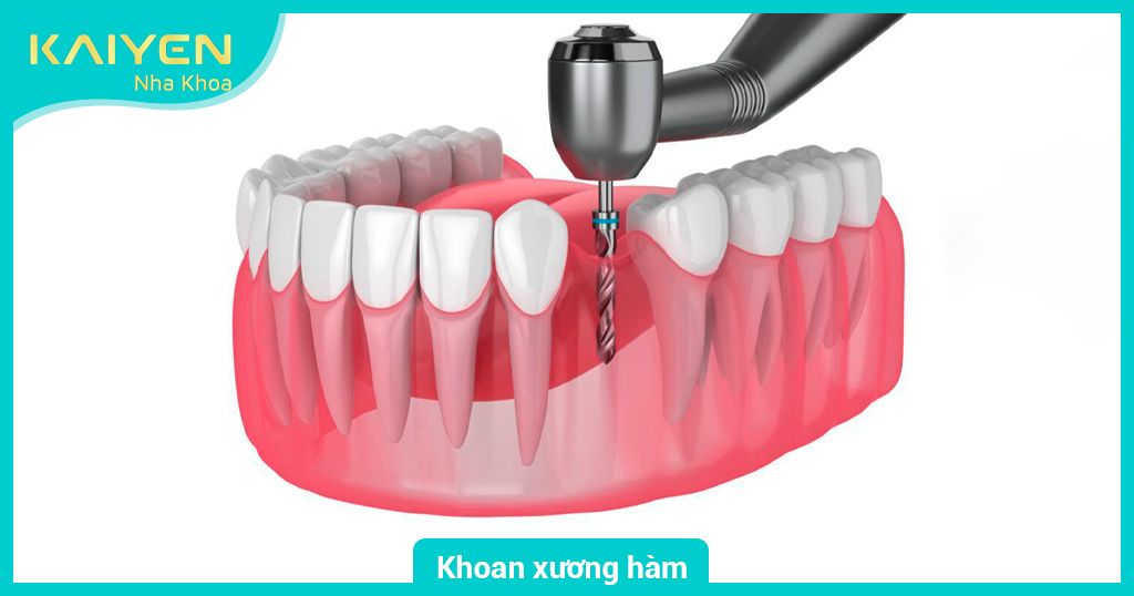 Kỹ thuật khoan xương hàm