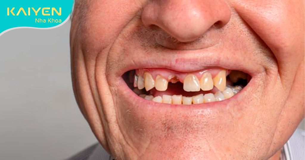 Gãy răng, mất răng do tuổi tác, lão hóa