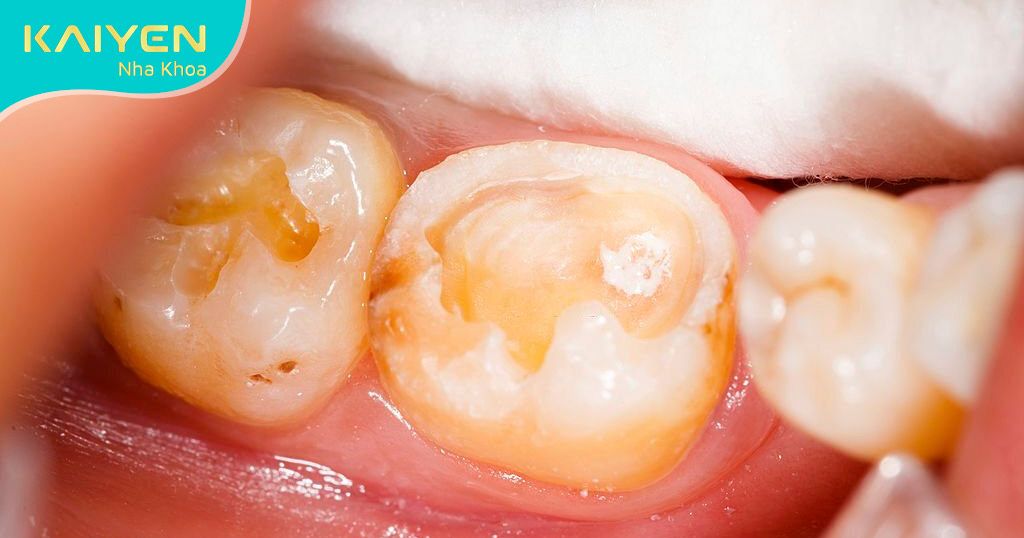 Răng bị gãy làm tăng nguy cơ mắc bệnh lý