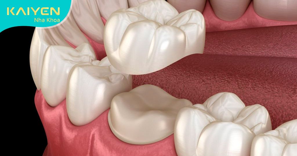 Bọc răng sứ bảo tồn phần chân răng khỏe mạnh