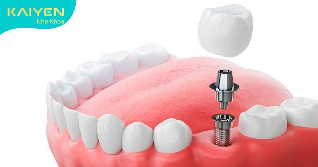 Trồng răng Implant – phục hình răng mất từ chân răng
