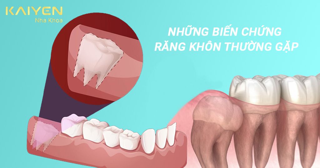 Răng khôn mọc gây ra những biến chứng gì?