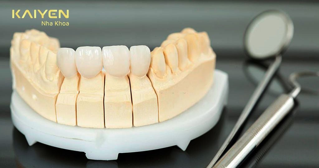 Kỹ thuật bọc răng sứ 4 răng cửa