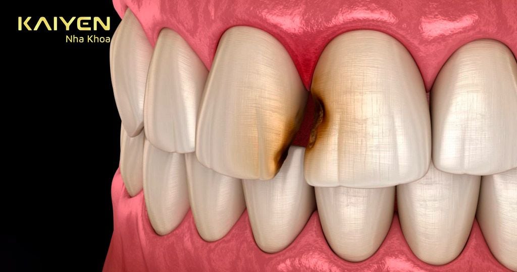 Bọc răng sứ giúp ngăn ngừa sâu răng cửa