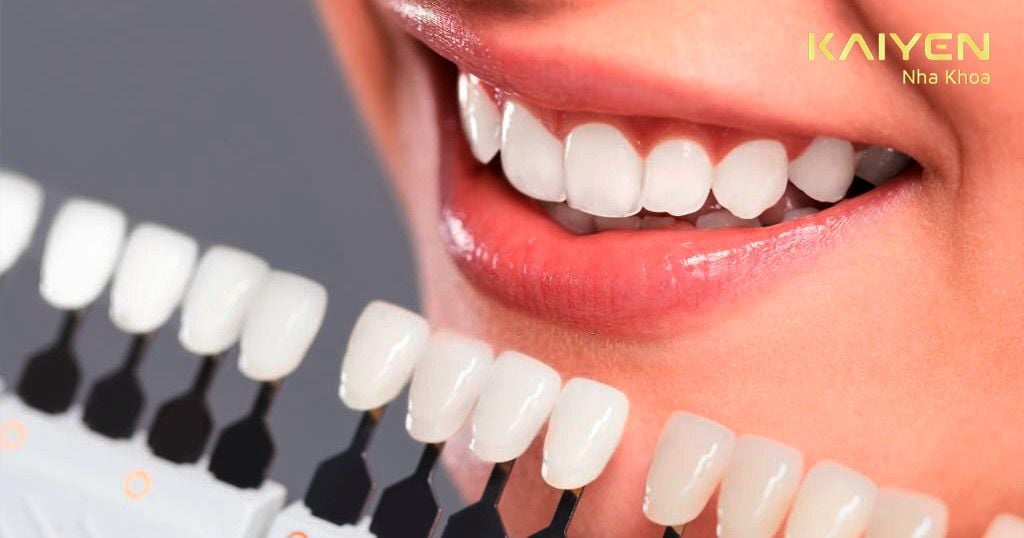 Răng toàn sứ có khả năng kháng màu cao