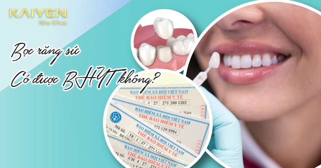 Bọc răng sứ có được bảo hiểm y tế chi trả không?