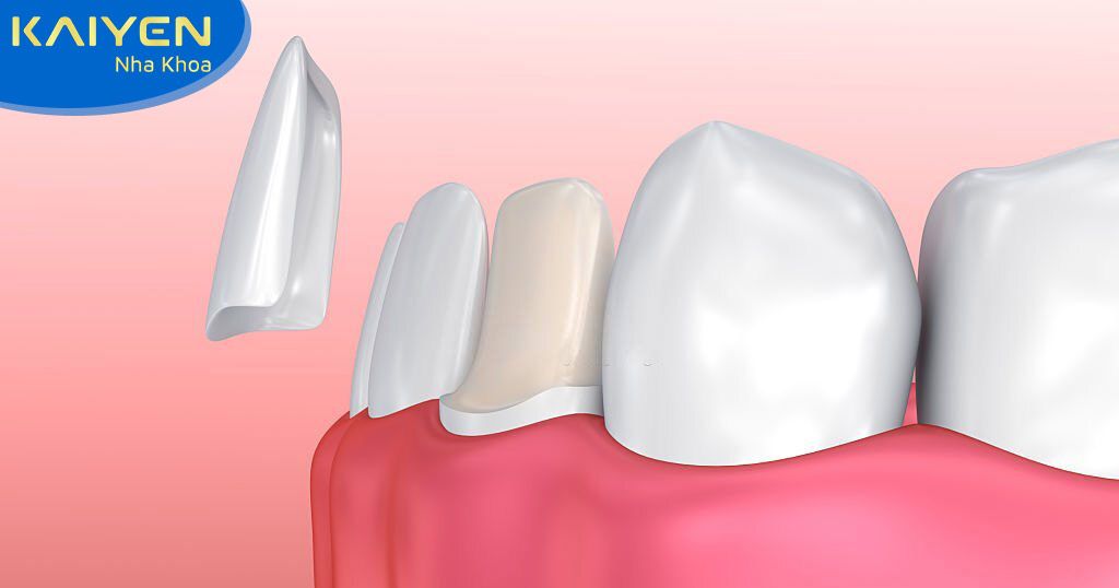 Bọc răng sứ không mài bằng công nghệ dán sứ Veneer