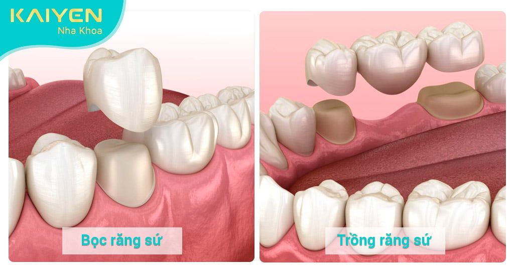 Bọc răng sứ và trồng răng sứ: So sánh chi tiết sự khác biệt – Nha ...