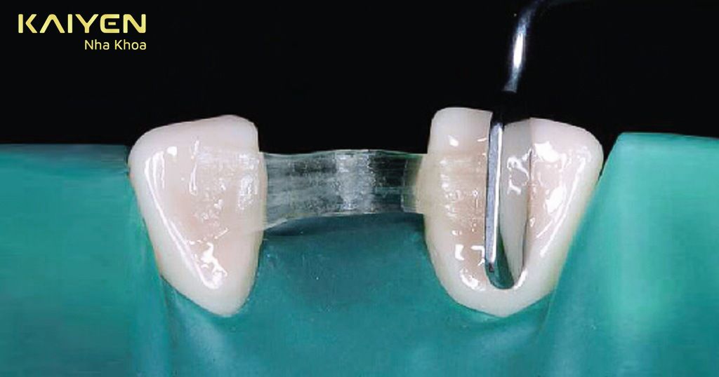 Cầu răng Composite