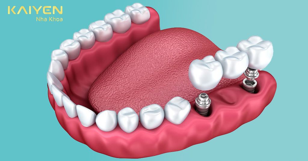 Cầu răng sứ kết hợp với trụ Implant