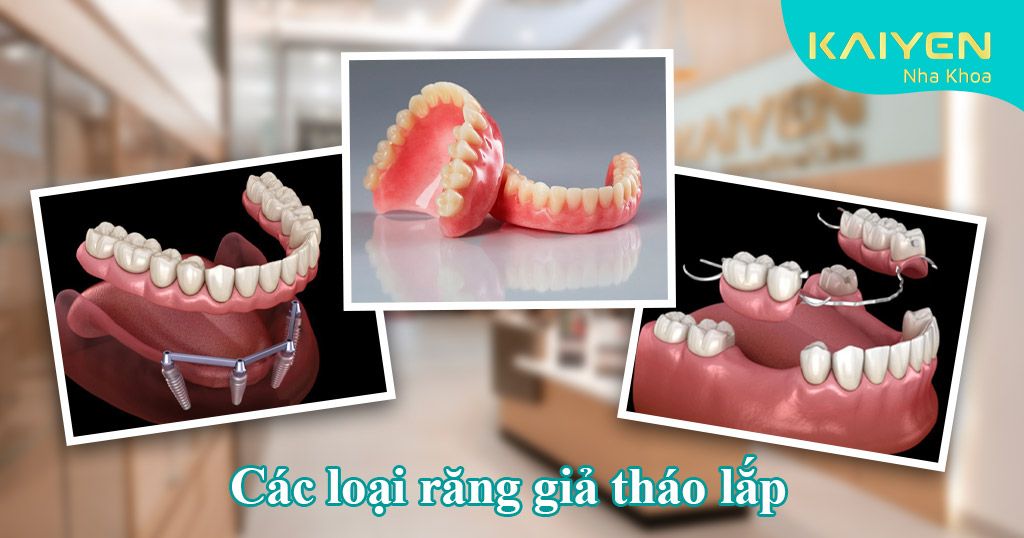 Các loại răng giả tháo lắp hiện nay