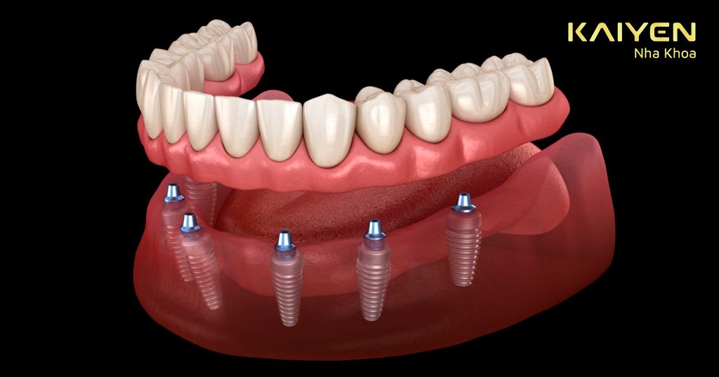 Răng tháo lắp trên trụ Implant All-on-6