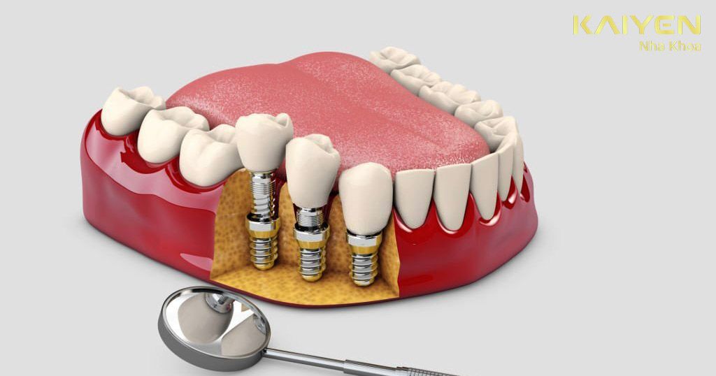 Có mấy phương pháp trồng răng? Loại nào tốt nhất hiện nay?