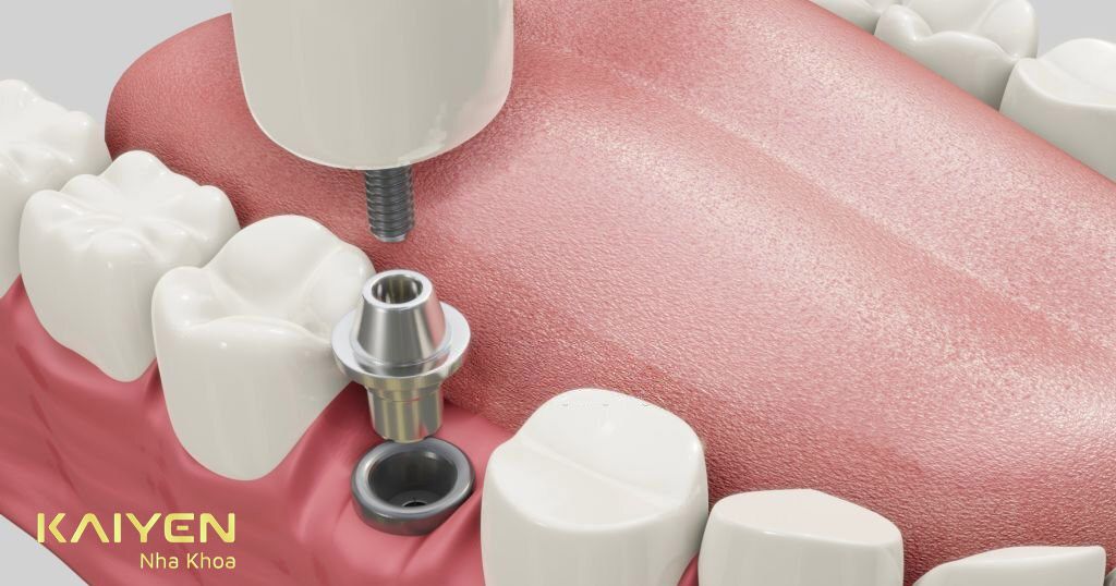 Cấy ghép Implant phục hình từ chân răng