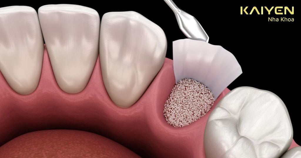 Ghép xương nhân tạo hoặc tự thân trước khi cấy ghép Implant