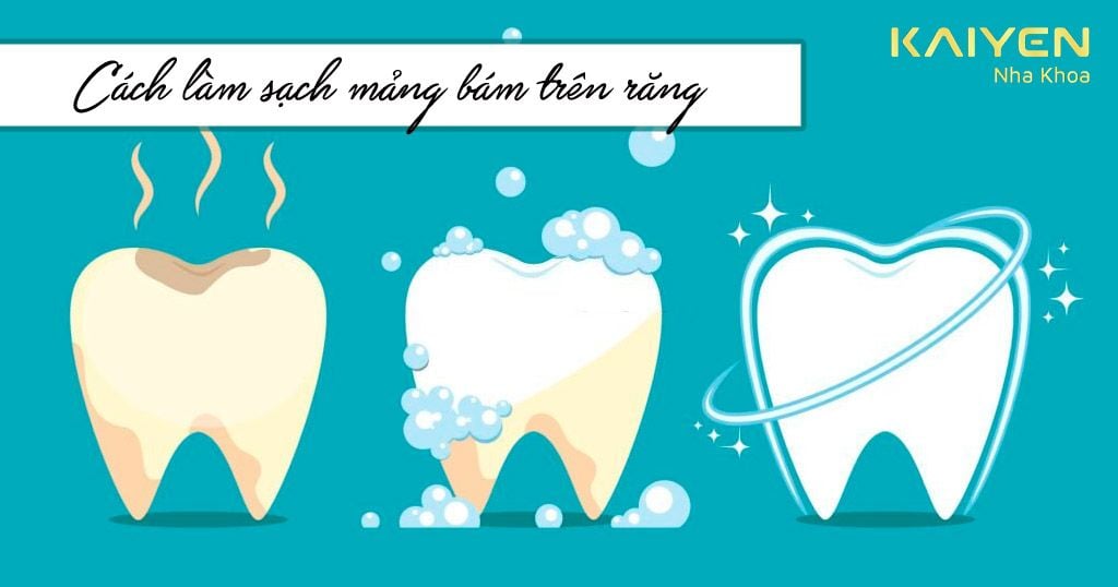 Làm thế nào để làm sạch được các mảng bám ố vàng trên răng?