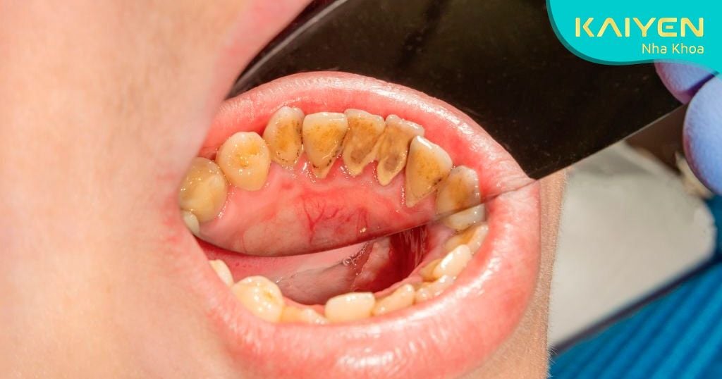 Mảng bám trên răng gây mất thẩm mỹ và tăng nguy cơ gây bệnh lý răng miệng