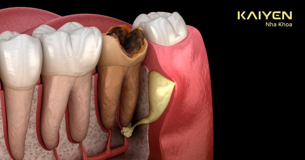 Điều trị dứt điểm các bệnh lý về răng miệng trước khi tiến hành cắm Implant