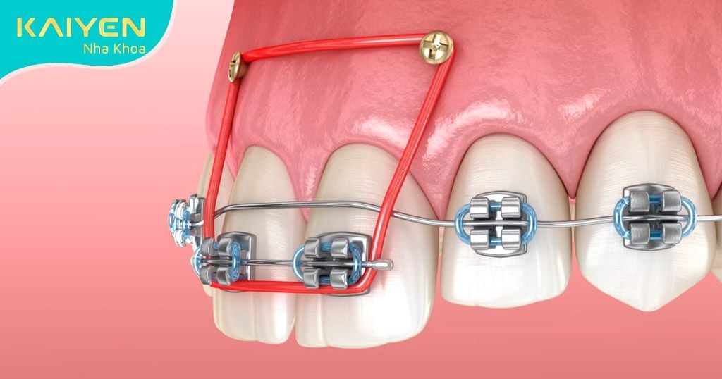 Minivis niềng răng là gì? Giá bao nhiêu? Cắm vít có đau không?