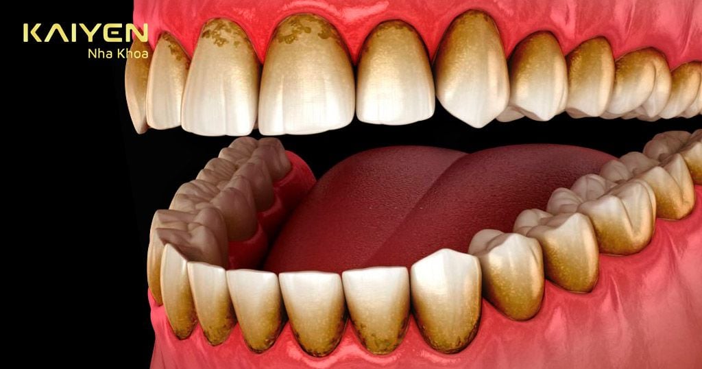 Nguyên nhân cao răng bị đen là gì?