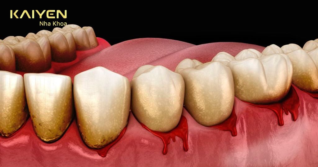 Cao răng bị nhiễm máu và chuyển dần thành màu đen