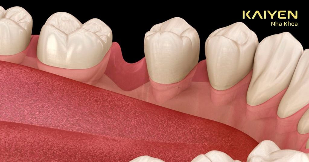 Cầu răng bị hở do xương hàm tại vị trí răng mất bị tiêu