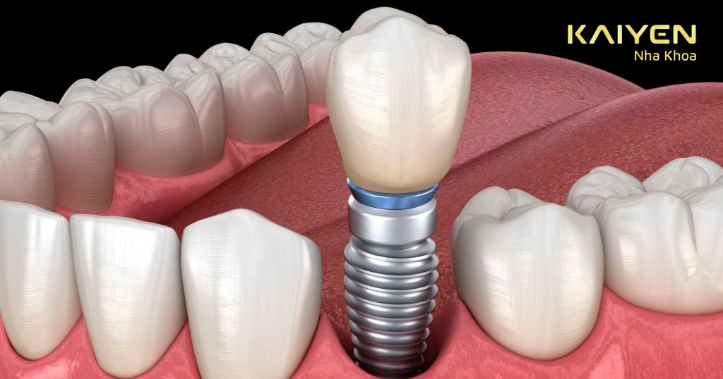 Cấy trụ Implant tại vị trí mất răng