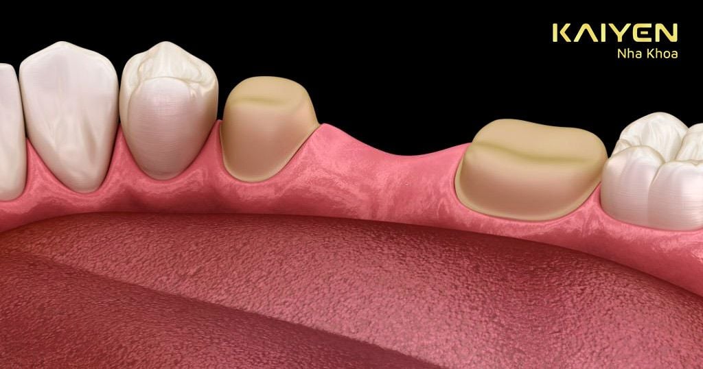 Cầu răng Titan được sử dụng trong trường hợp mất 1 – 2 răng
