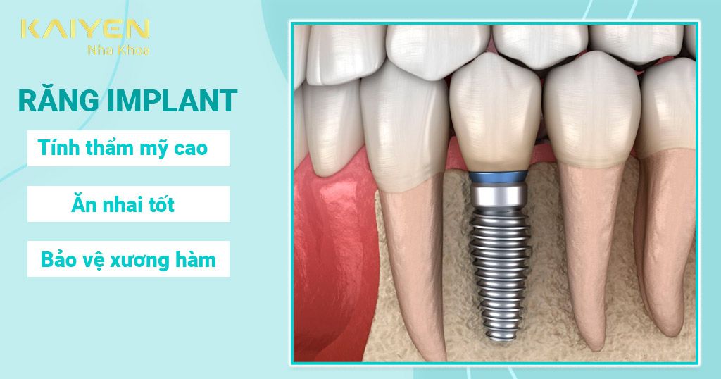 Răng Implant mang lại chức năng ăn nhai tốt, thẩm mỹ cao