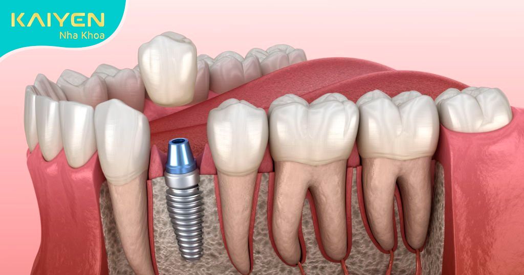 Trụ Implant có khả năng tương thích tốt với xương hàm